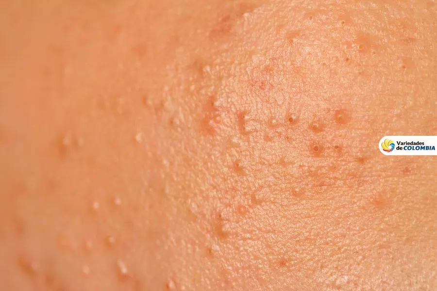 acne persistente acné persistente
