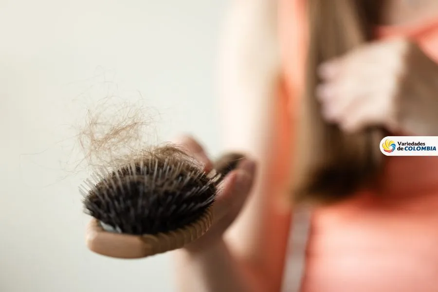 alopecia androgenetica alopecia androgenética