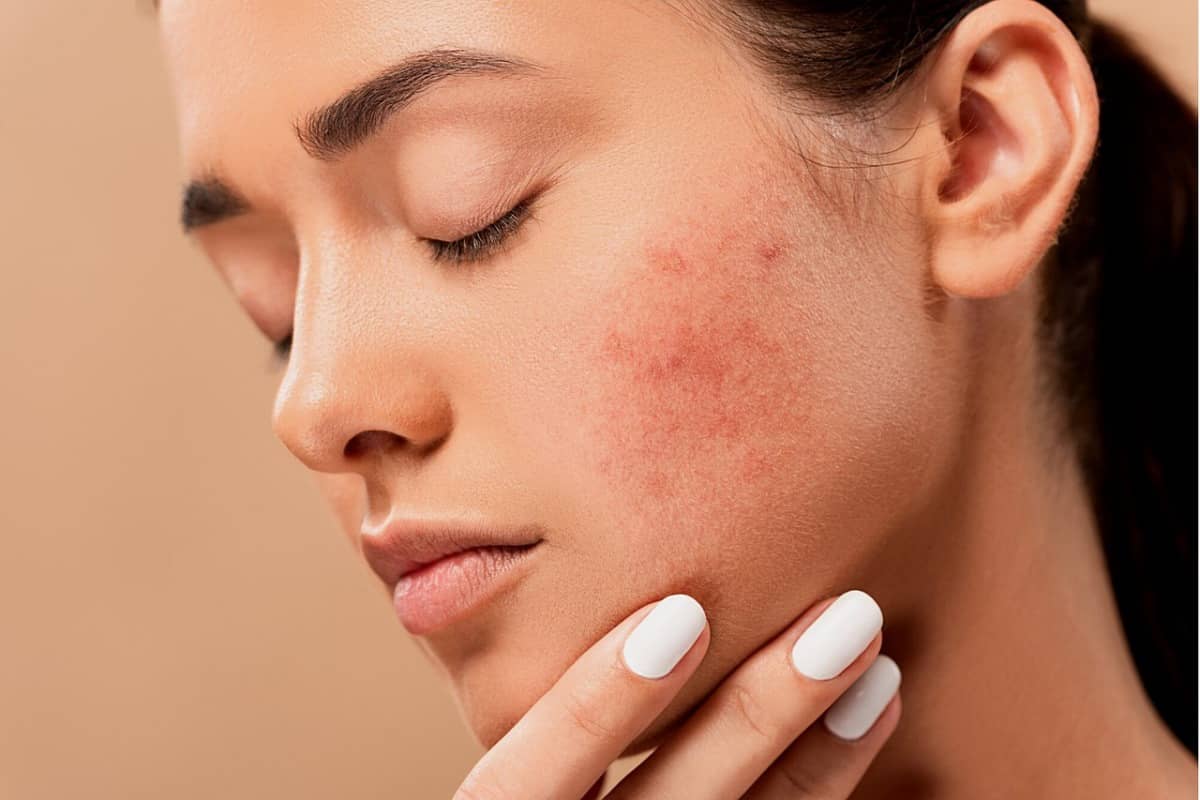 combatir el acne naturalmente