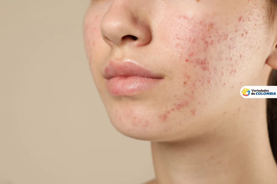 reducir acne Reducir acné