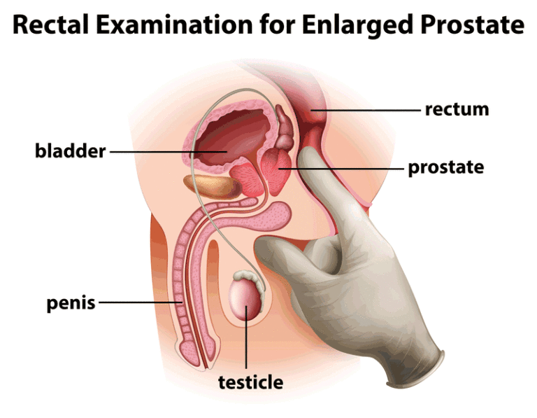 Evita el Cáncer de Próstata