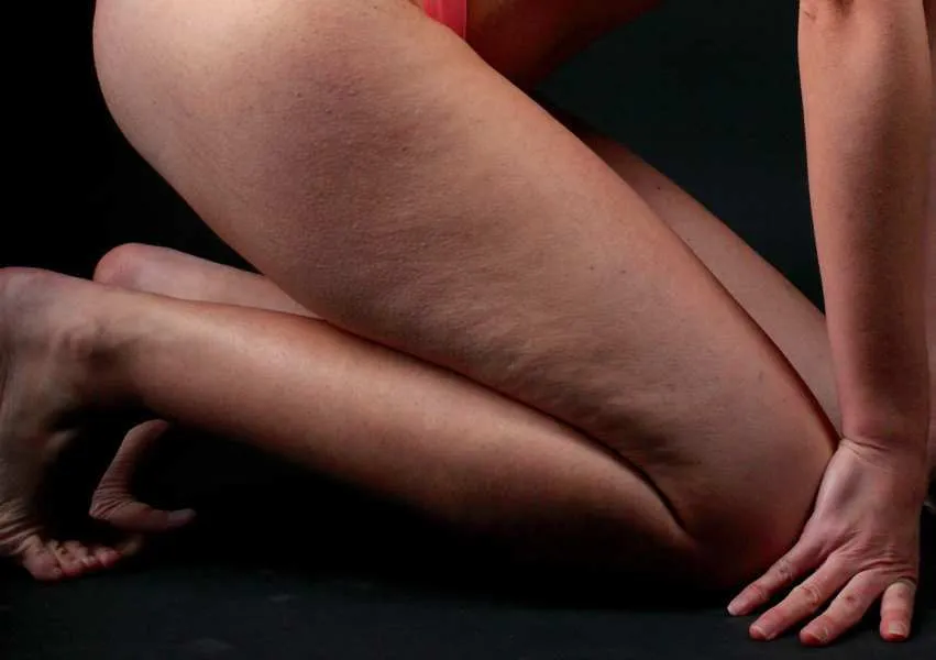 Ejercicios para prevenir la Celulitis fácilmente Ejercicios para prevenir la Celulitis