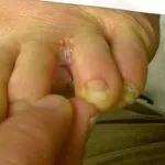 Micosis Cutanea