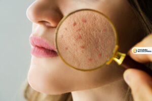 Piel grasa en el rostro: consejos infalibles para controlar el brillo y lucir radiante
